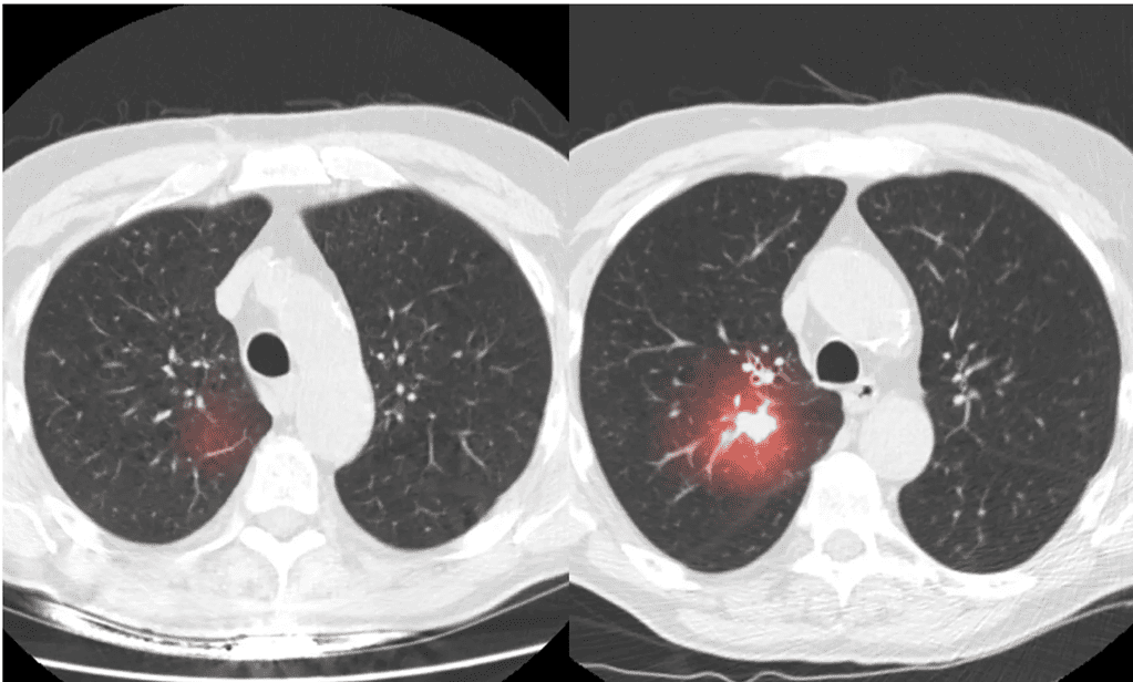 dépistage du cancer du poumon nejm